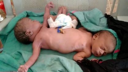 Na Índia nasceram gêmeas siamesas 