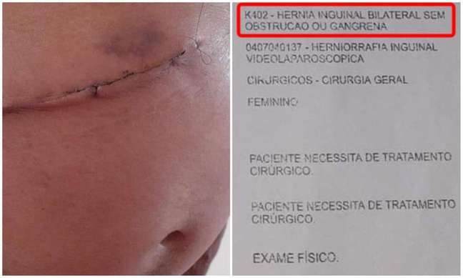 Homem leva 11 anos para retirar hérnia e fica sem vesícula