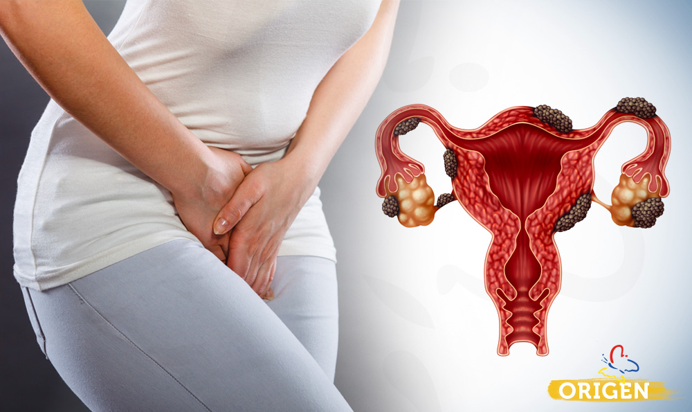 Endometriose: entenda o que é e qual o tratamento