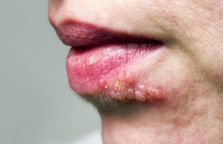 Herpes labial: saiba o que é essa infecção e seus sintomas