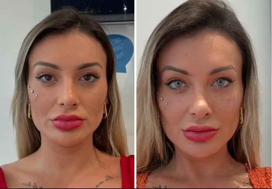 Andressa Urach faz cirurgia para mudar a cor dos olhos e se arrepende: 'Muita dor'