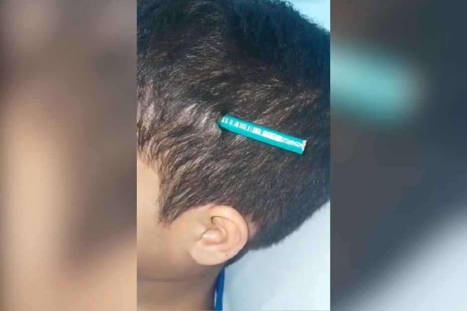 Menino de 9 anos fica com lápis cravado na cabeça após agressão de colega em escola
