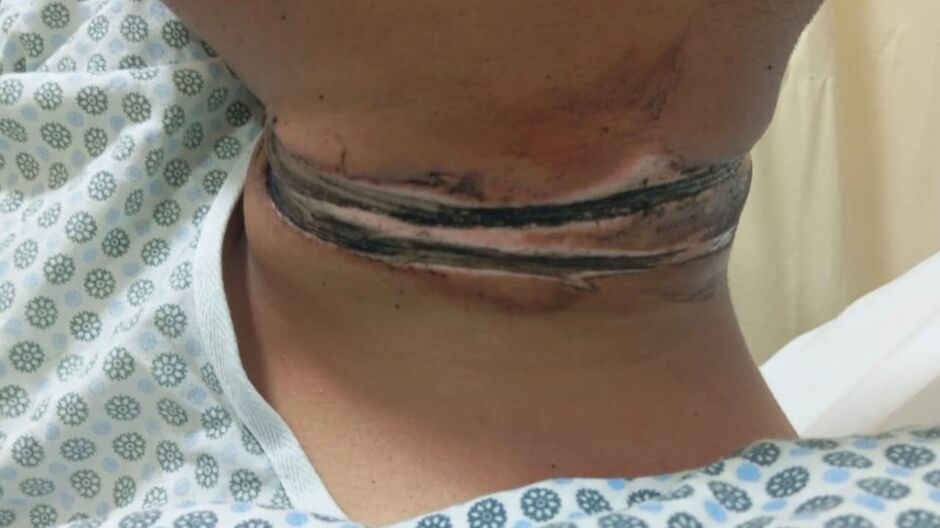 Jovem é enforcado por fios soltos e sofre grave acidente em MS