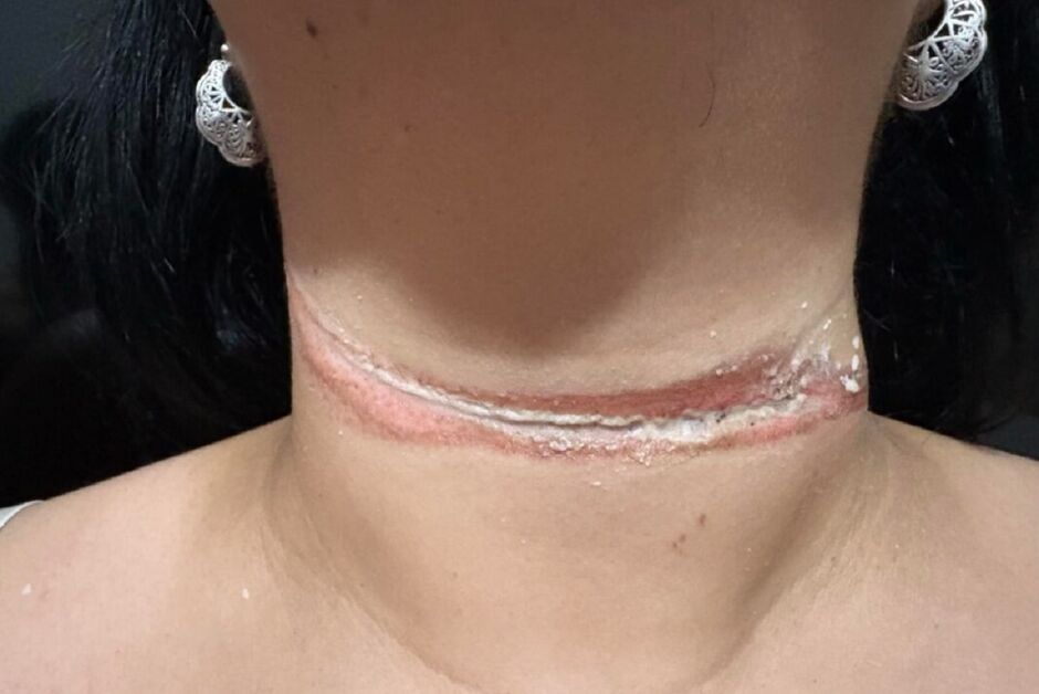 “Por pouco não morri”: professora de MS relata acidente com fio solto de internet