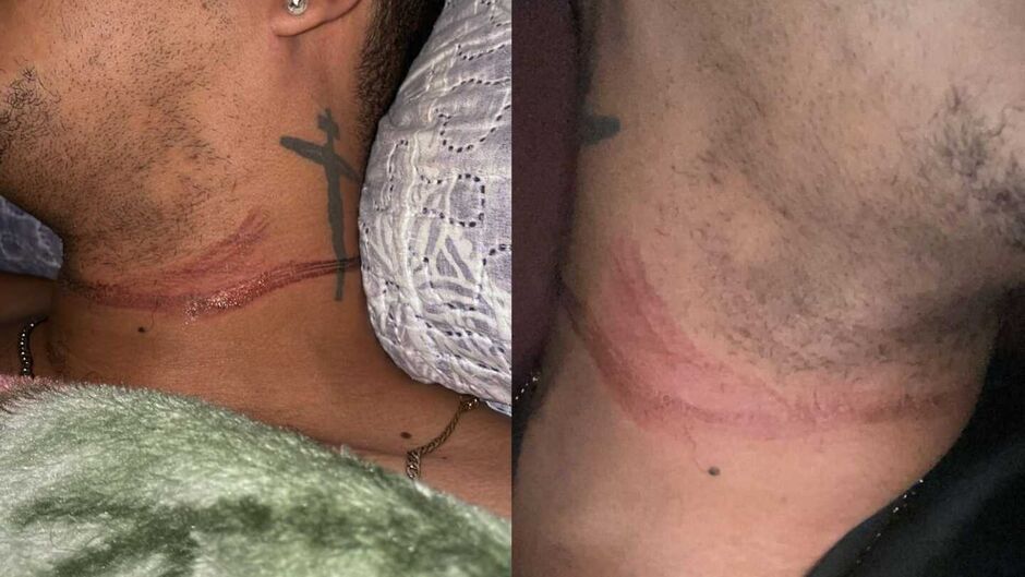 Fios soltos causam novo acidente e jovem é quase degolado em MS