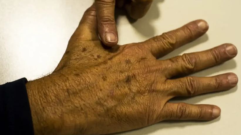 Mutirão gratuito contra câncer de pele será realizado em Dourados e Campo Grande no dia 13 de Dezembro