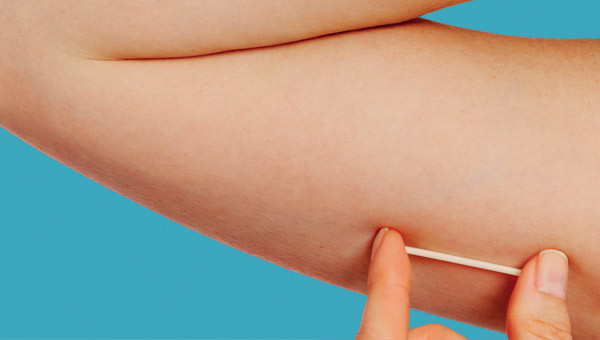 HU realiza mutirão com DIU e Implanon, mas atendimento seguirá critérios médicos